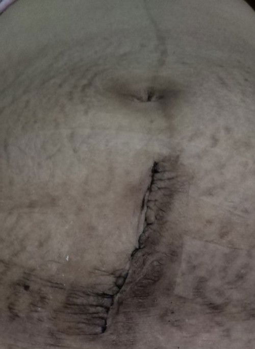 Pasintabi po. Tanong kolang po sa mga na cs din po. May ta tanggalin papo bang sinulid dyan sa sugat