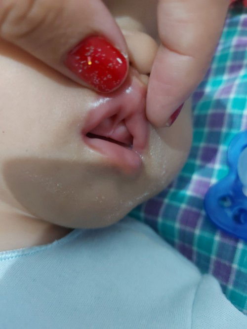 Lip tie pada bayi 4 bulan