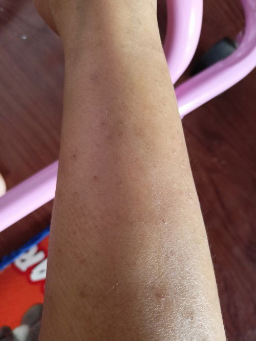 Salep gatal ibu menyusui