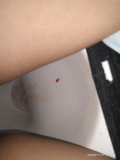 Normal bang nasakit ang balakang ng isang buntis at nahihirapan sa pagdumi sa third trimester? TY