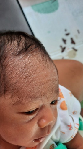คลอดน้องได้17วันมีผื่นที่หน้าผากแบบนี้ต้องซื้อยามาหรือผื่นจะหายเองคะ