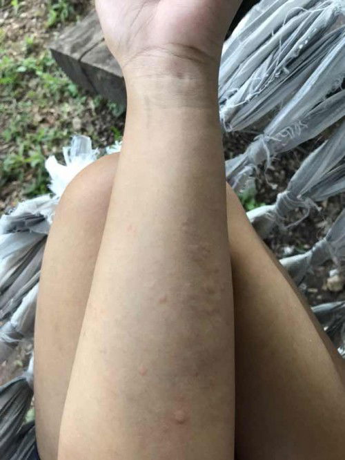 แพ้น้ำเต้าหู้ หรือ ลมพิษคะ