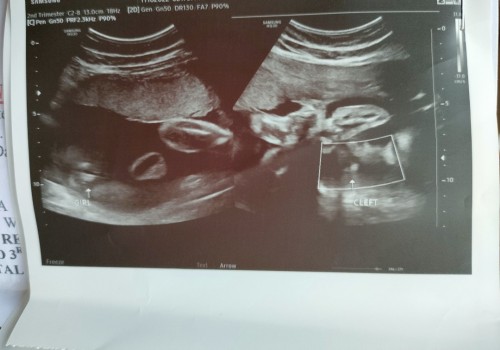 Congenital anomaly scan