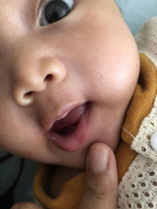 Tompok putih bibir baby