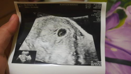 Hamil 6w baru trlihat kantung dan kuning telur saja