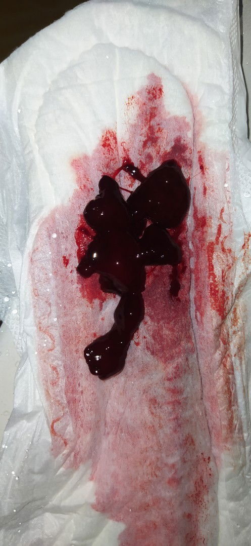 Assalamualaikum. Mw tany bun, apa ada yg pnya pnglaman sprti ku ini, haid gak berenti 1bulan lebih