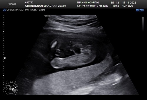 ผลอัตตราซาวด์ 18 week