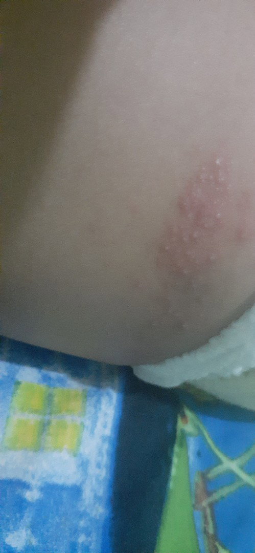Ruam pada bayi