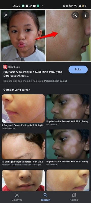 BERCAK PUTIH KULIT ANAK