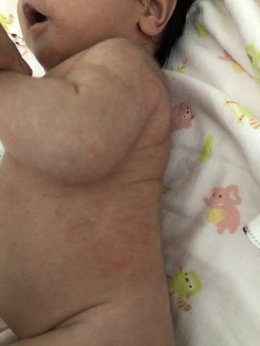 รบกวนสอบถามแม่ๆค่ะ ผื่นแบบนี้จะหายไปเองไหมคะ