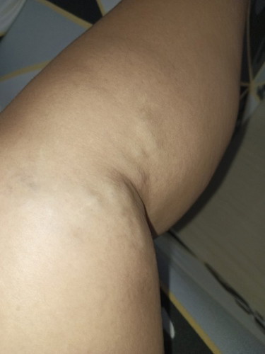 Varicose vein