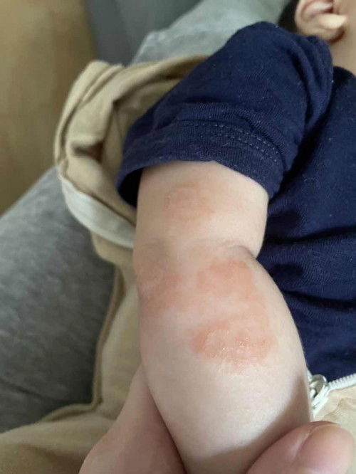 Is this a rash or what?