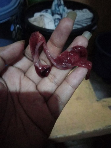 Miscarriage
