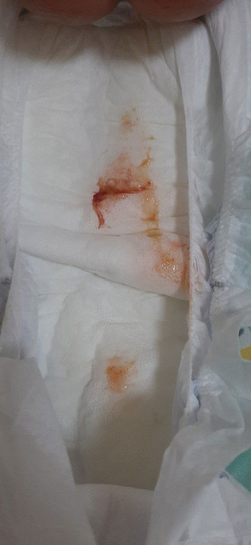 mga mommy bakit poh kaya ganito pupu ng baby koh..ntatakot ako kasi kakavaccine q lang din