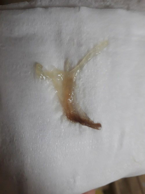 อันนี้เรียกมูกปกติหรือมูกเลือดคะ