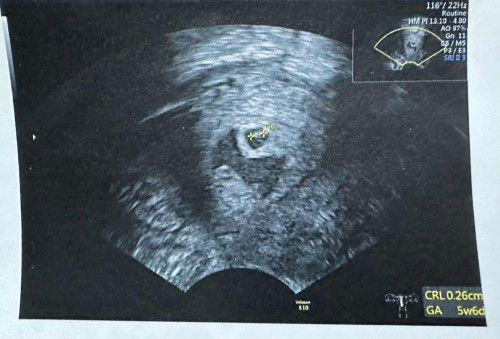 ค่า HCG ลดลง ซาวน์เจอน้องและเลือด แท้งค่ะ