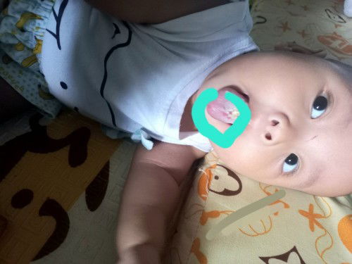 Lidah bayi seperti ada bercak/bolong