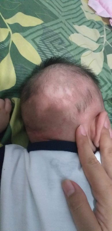 Kulit kepala bayi putih2 rambut tidak tumbuh