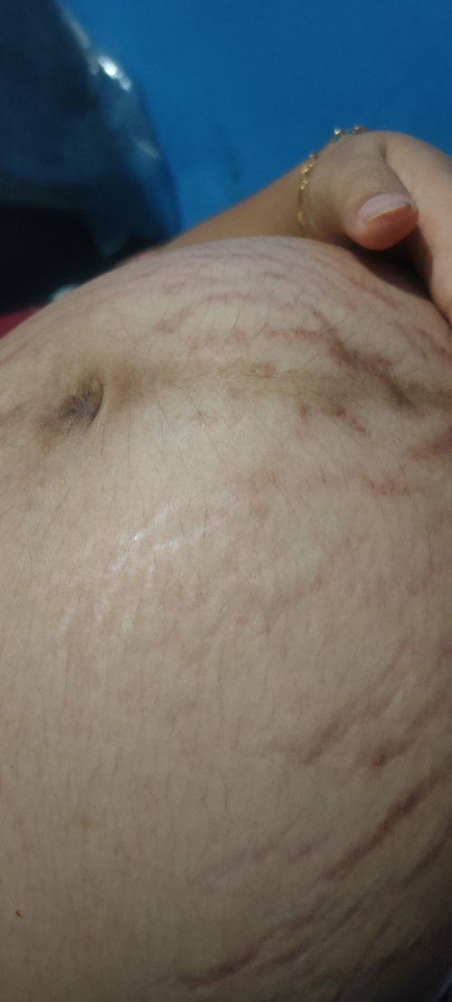 Stretch mark