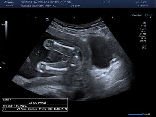 เด็กอ้วน 20 วีค ของแม่จ๋า