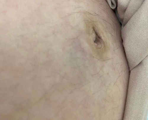 ระหว่างตั้งครรภ์