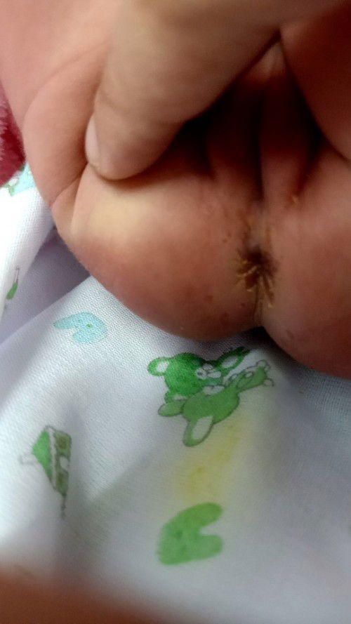 แม่ๆคะพอดีเราเป็นคุณแม่มือใหม่ตูดลูกเป็นแบบนี้ทำยังไงดีคะแม่ๆช่วยแนะนำหน่อยค่ะสงสารลูกมากค่ะ