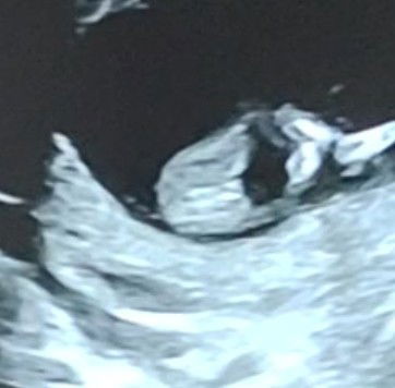 Gender reveal boy or girl