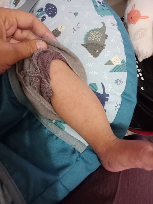 Bun bayi saya 5bln bintik2 merah di kaki+tangan, kemaren baru sembuh dr demam, gimana ya solusinya?