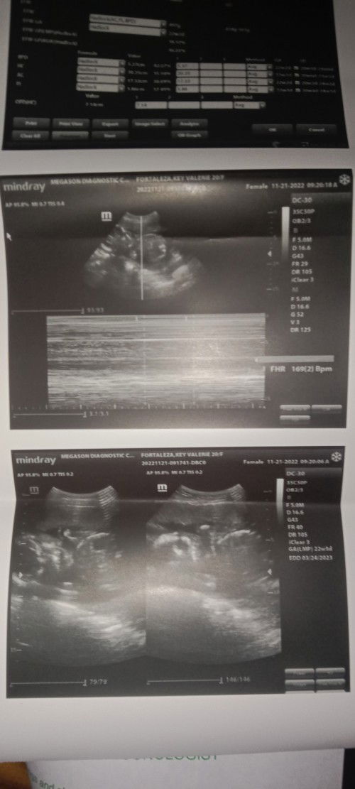 BAKIT PO DI PA MAKITA ANG GENDER NG BABY KO 22WEEKS AND 2 DAYS NAPO.