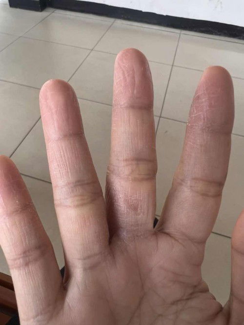 Hamil 11w tangan kering dan gatal