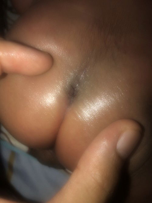 Sacral dimple (lesung bokong)