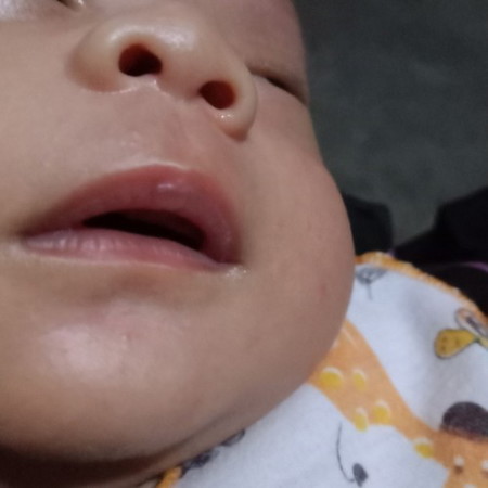 Bun, ini knp y? Bibir atas anak saya ber gelembung putih, apakah normal?