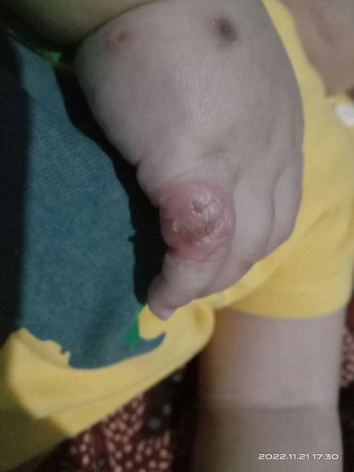 Tangan bentol berair