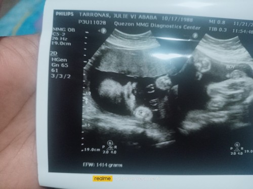 Pwd Po ba mag kamali Ang ultrasound na may cleft lip Ang baby ko . 29 weeks