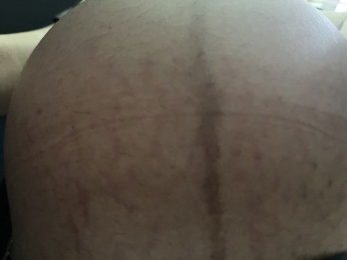 ท้องเริ่มแตกลาย