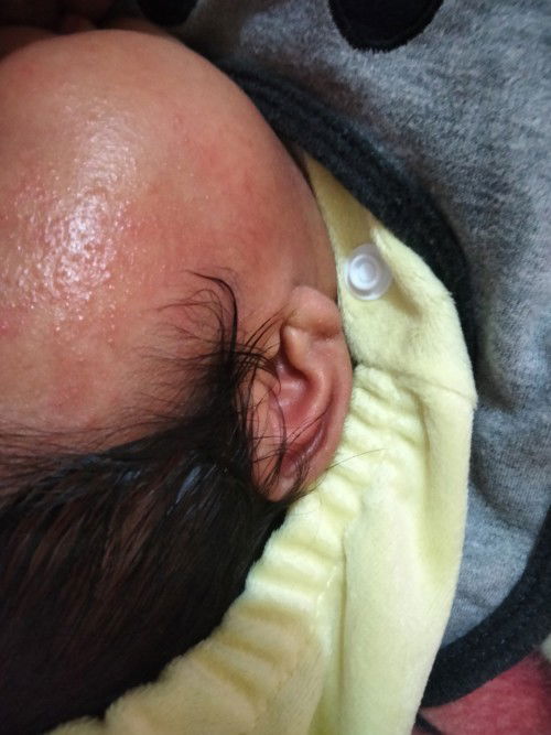 Bintik merah bayi umur 1bln