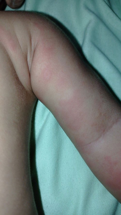 Gabagen/ruam merah setelah demM