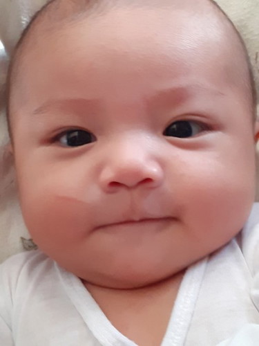 Sugat ni baby