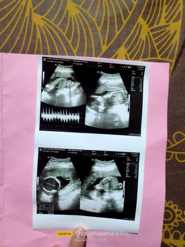 Foto hasil USG janin sujud