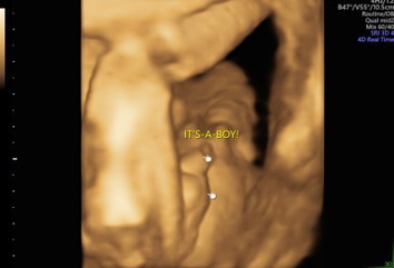 It's a boy!!!