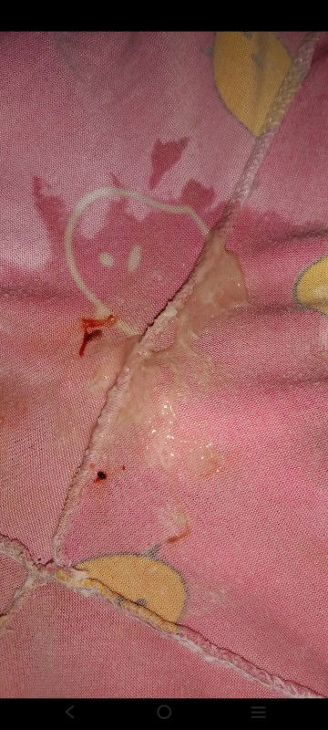 มีมูกแบบนี้อันตรายไหมค่ะ