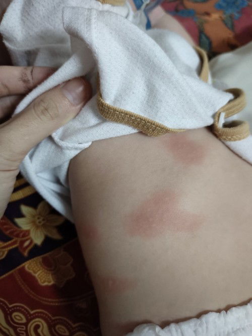 Merah merah pada kulit bayi