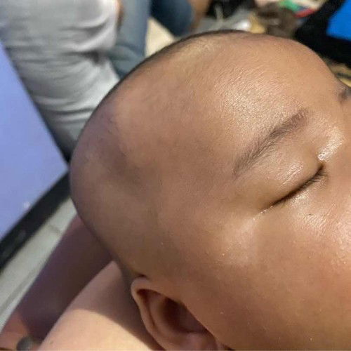 Kulit Muka Bercak Putih