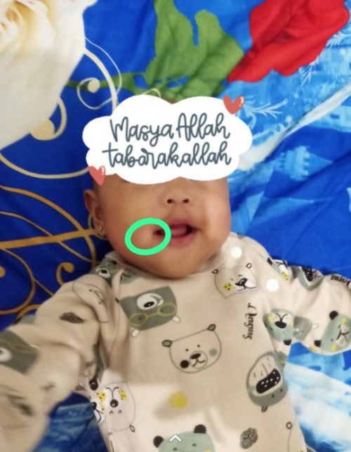 putih putih sekitar mulut bayi