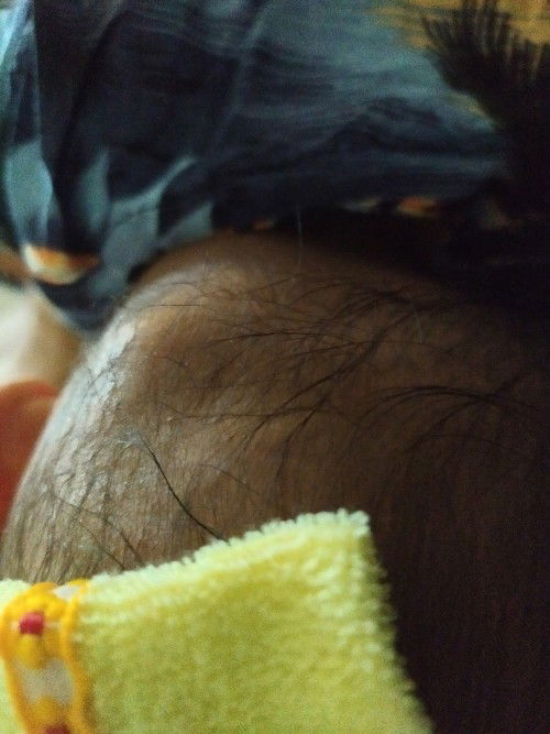 Benjolan dibelakang kepala bagian tengkorak