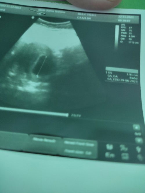 Hamil 9 minggu belum terlihat janin