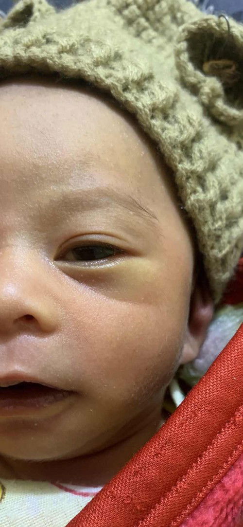 Bayi kuning krn dehidrasi