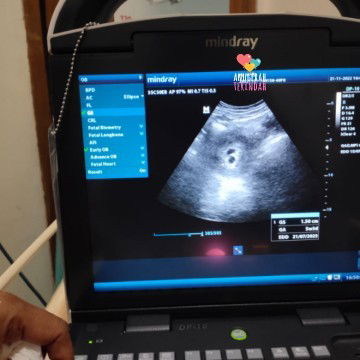 Ini ada 2 kantung janin apa satu tapi terhalang jadi seperti 2 kantung.