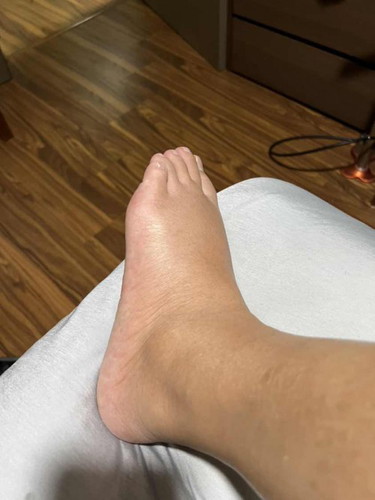 Feet swelling: Normal or Too much?