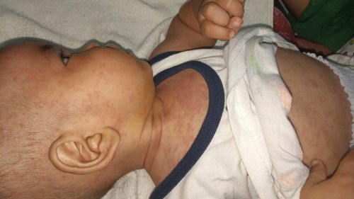 moms,aku mau tanya kalo ini tampek bukan?
soalnya udh keluar semua seluruh tubuh.
mnm klpa ijo blh?